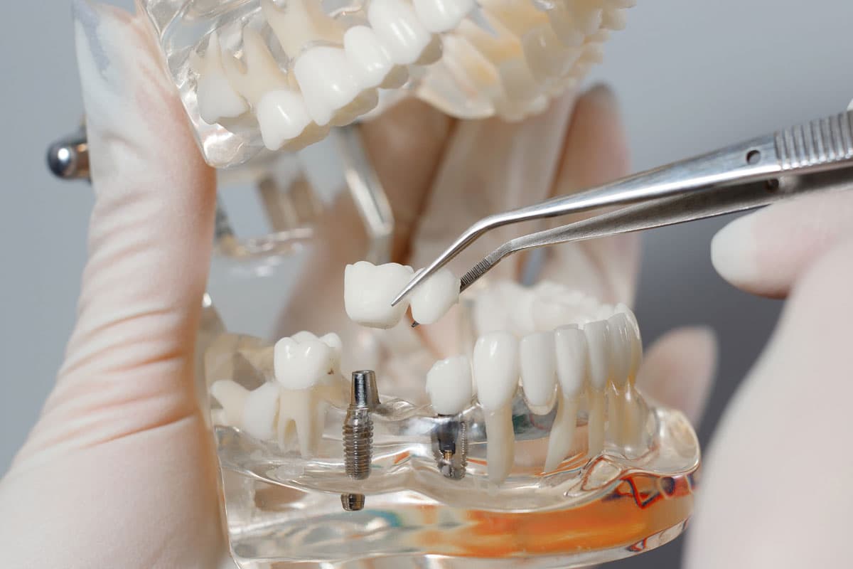 Implantes de dientes en Lugo