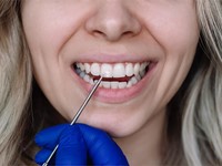 ¿Qué alimentos dañan el esmalte dental?